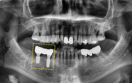 [Seokchon Gobun Station Dental Clinic] When Is an Implant Needed? image 7