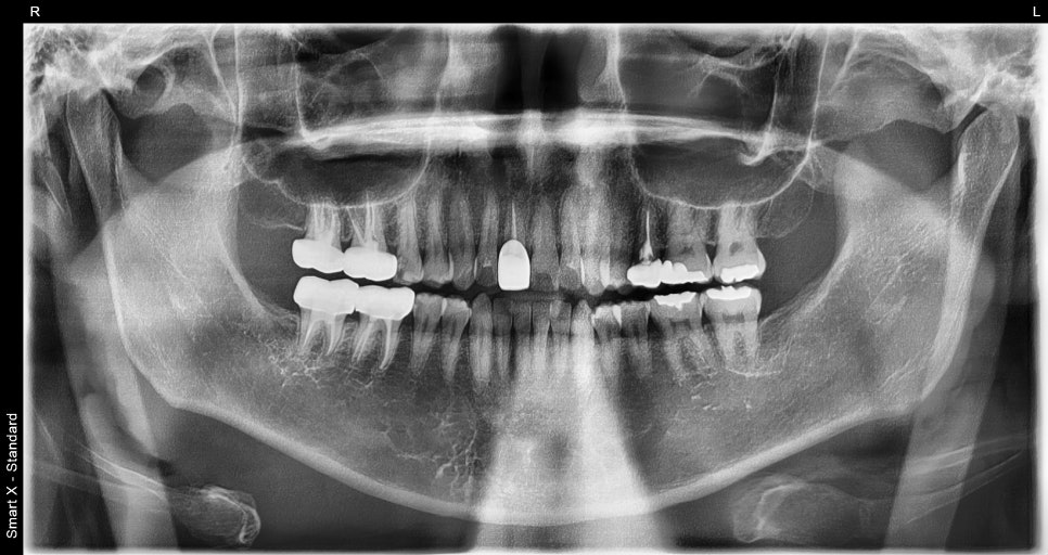 When a molar breaks, do you always need an implant? image 14