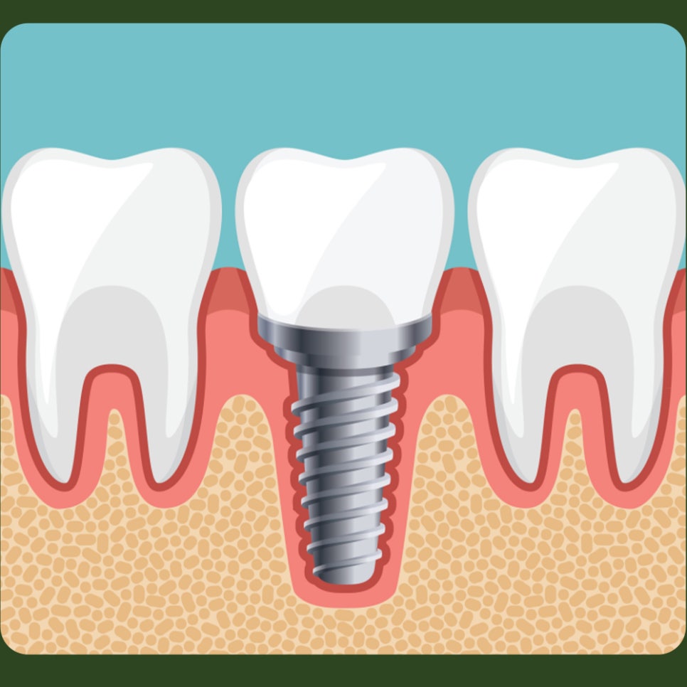 Post-Implant Care Instructions—Let’s Take a Look Together! image 2