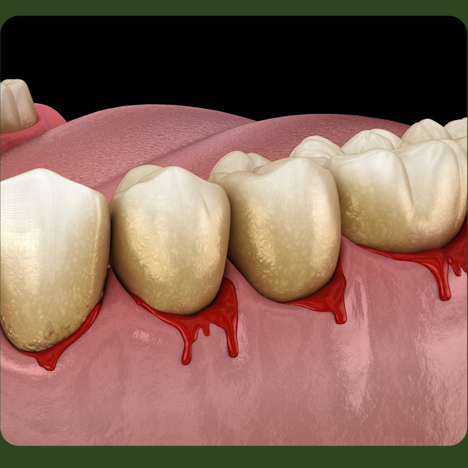 Why Do Gums Bleed? image 2