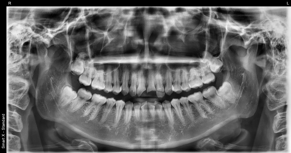 Songpa Dental Clinic, a Case of Crown Restoration After Root Canal Treatment for a Woman in Her 20s With a Broken Front Tooth image 3