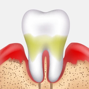 Half of Adults Are Leaving It Untreated?! Restore Healthy Teeth with Gum Treatment image 4