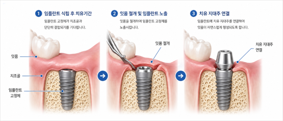 What Is Second-Stage Implant Surgery? Find Out Here! image 3