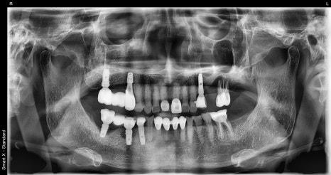 Implants Possible Even in Your 90s: Real Cases from Seoul Above Dental Clinic! image 5