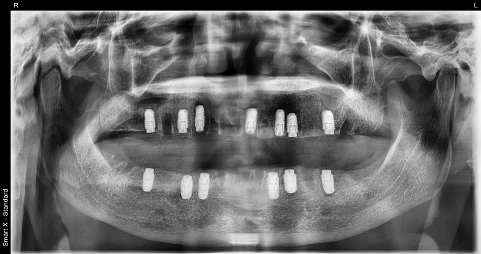 Full-Mouth Implant Price: Treatment for a Patient Over 65 Performed Under Sedation image 6