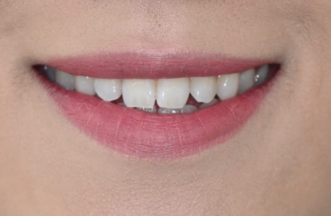 The Real Reason for the Price Difference in Laminates: See for Yourself with OVZERO Minimally Prepared Veneers image 15