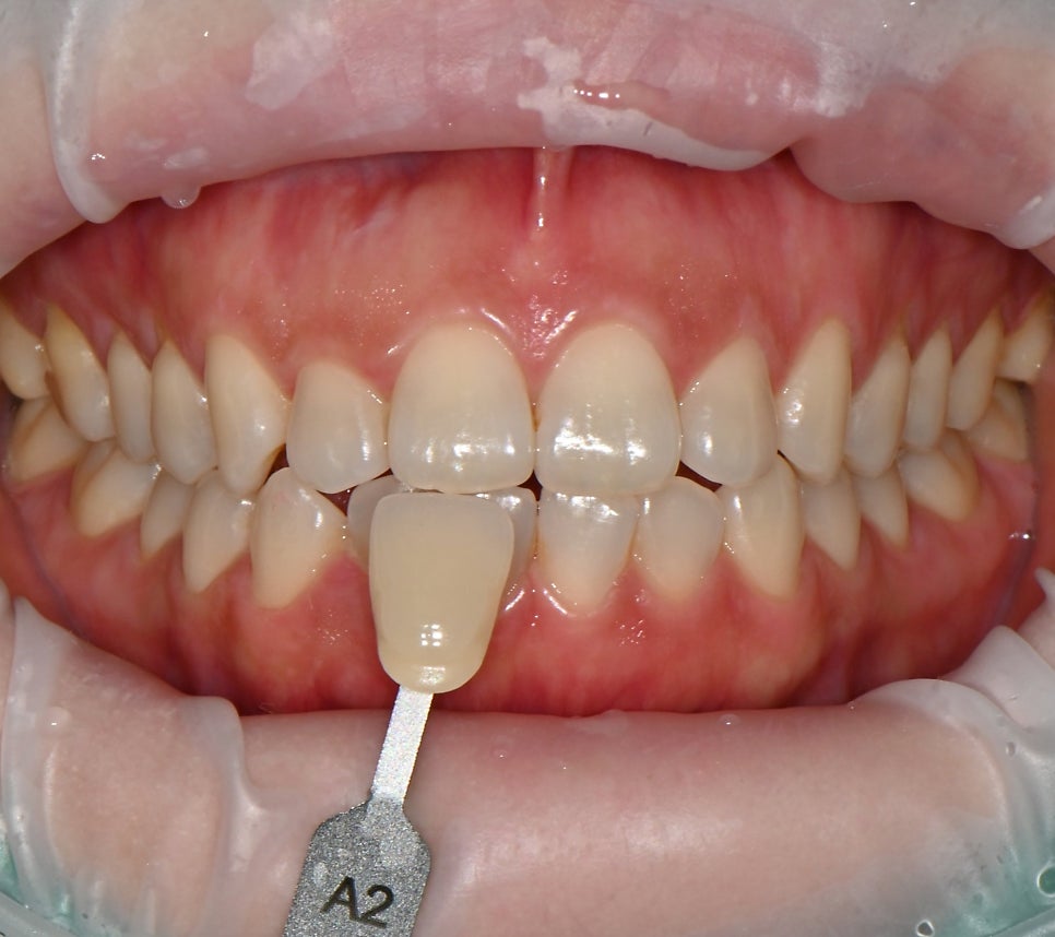 Tone Up Your Teeth in Just One Day! A Whitening Treatment Review at Seoul Of Dental image 2