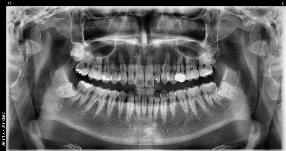 Object Zero Front Tooth Laminate, Minimizing Tooth Reduction image 6