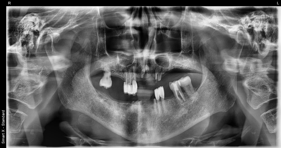 If Your Denture Keeps Coming Loose, What Should You Do? A Real Case Solved with Insurance-Covered Implant Dentures image 2