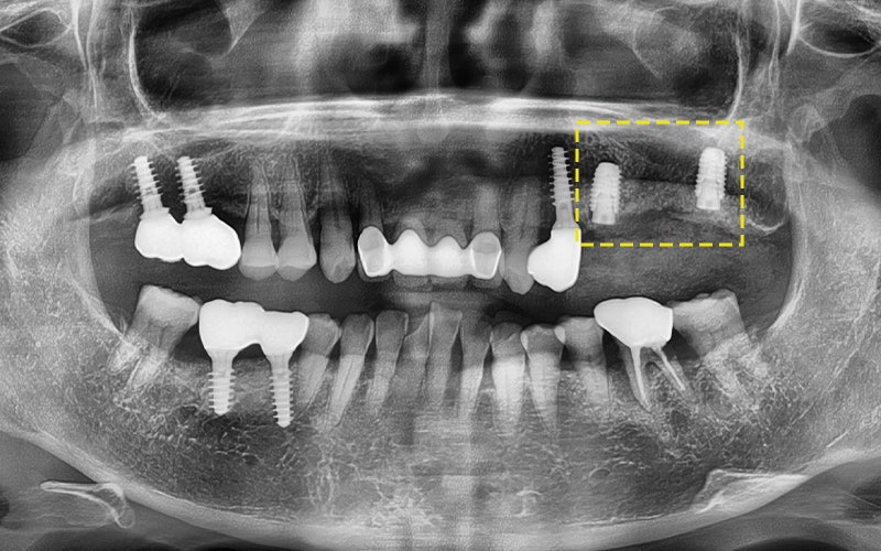 Samjeon Station Implant: Why do some break while others can last a lifetime? image 8