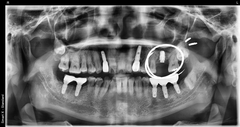 어금니 임플란트가격, 임플란트치과에서 진행한 실제 치료 과정 관련 이미지 11