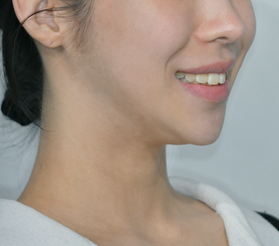 Objeo Laminate Cost, Treatment Review from a Woman in Her 20s image 13