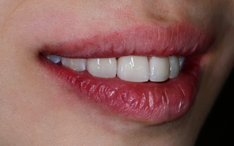 Objeo Laminate Cost, Treatment Review from a Woman in Her 20s image 10