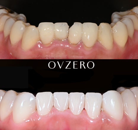 Retreating Front Tooth Damage and Prosthetic Fracture with OVZERO Laminate! image 2