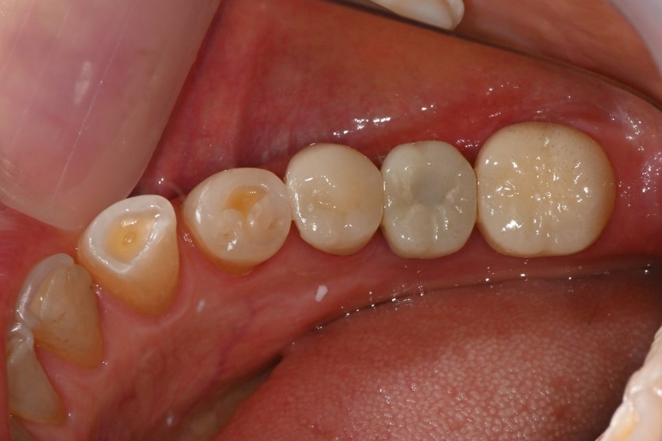 Front Tooth Crown + Implant for an Overseas Patient: What Made It Possible to Finish in 4 Months? image 8