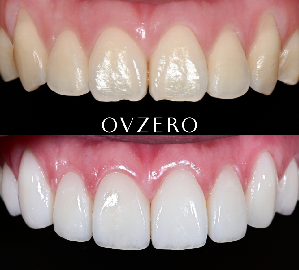 Samjeon Station Dental Clinic: "Without Orthodontics, Object Zero for the Smile Line of a Woman in Her 20s" image 2