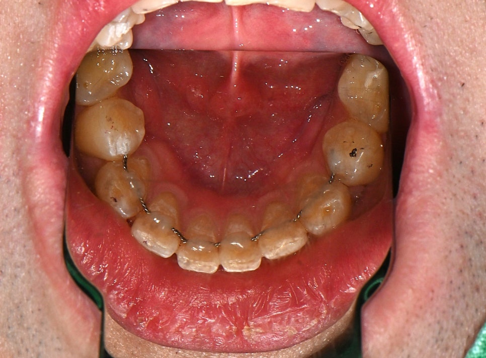 What If Your Orthodontic Clinic Has Closed? What to Do When a Retainer Falls Off image 3