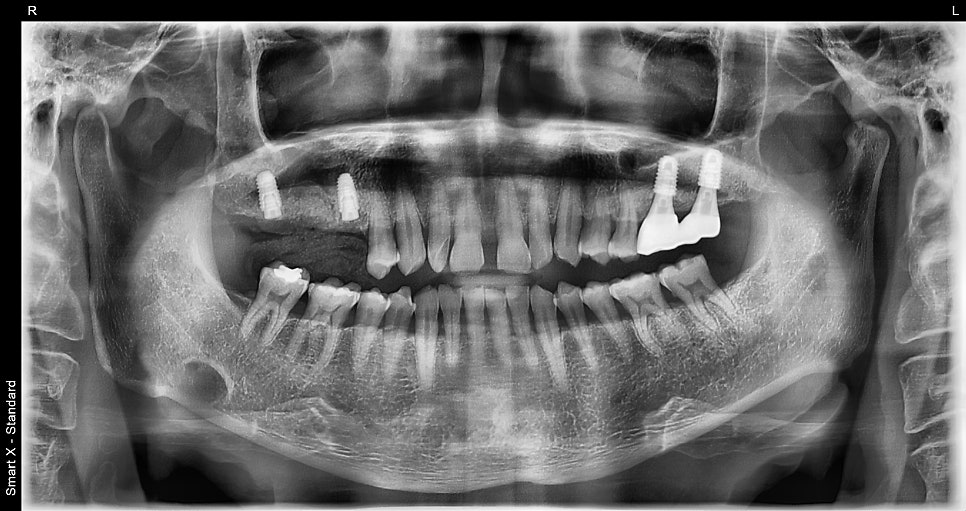 Don’t wait after extraction—place it right away! The golden time when bone comes back to life image 3