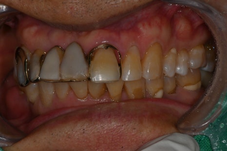 Understanding Implant Price Differences Through the Molar Implant Process image 6