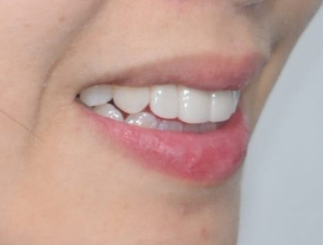 Laminate Veneers for Protruding Teeth: If They’re Too Thick, They Look Even More Prominent image 14