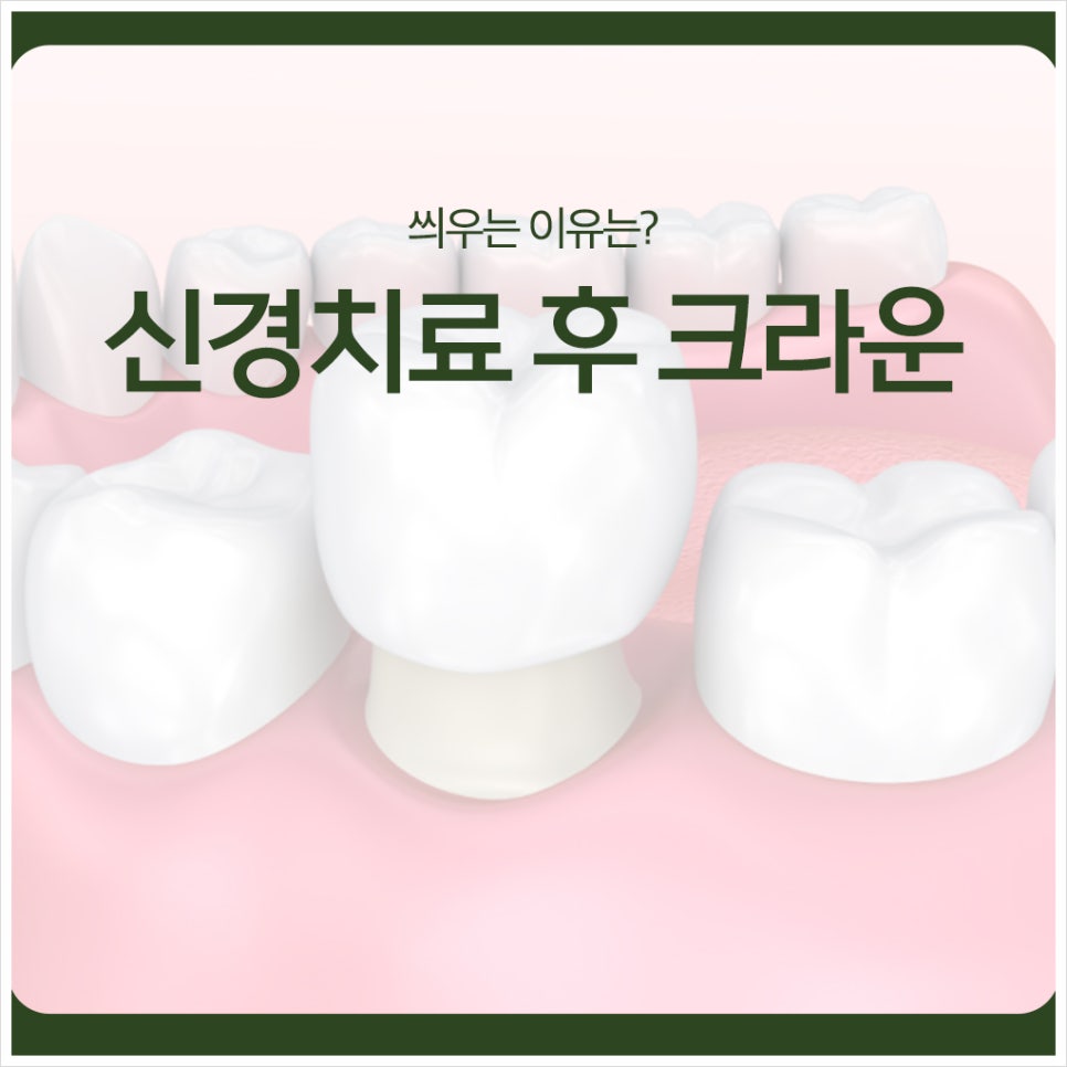 Why Is a Crown Placed After Root Canal Treatment? image 1