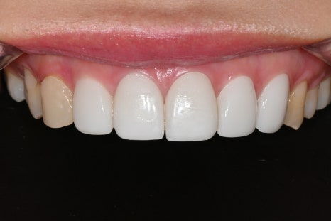 Can a laminate veneer received at another clinic be redone? image 2