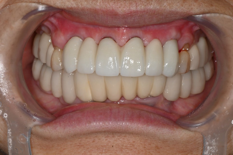 앞니 임플란트, 전치부 심미까지 살린 치료 과정 정리 관련 이미지 16