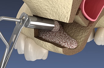 Implant Reoperation: Don’t Give Up. image 4