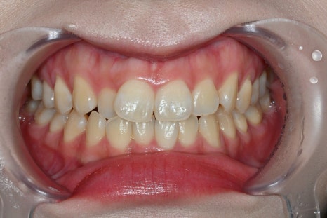 Why the Front Teeth Laminate Changed Naturally with Obzero Laminate image 3