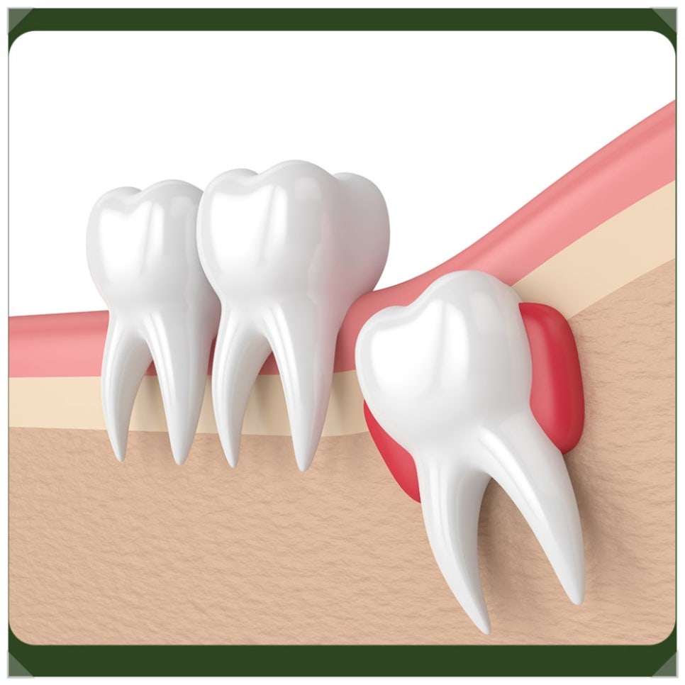 Pain After Wisdom Tooth Extraction: If It’s Getting Worse, Please Read This! image 3