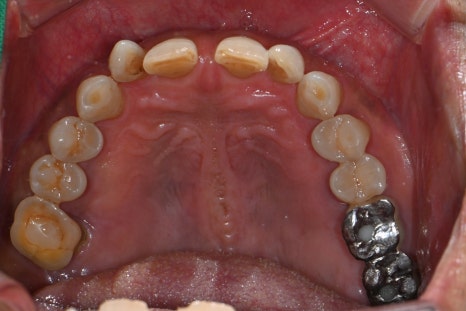 Don’t wait after extraction—place it right away! The golden time when bone comes back to life image 2