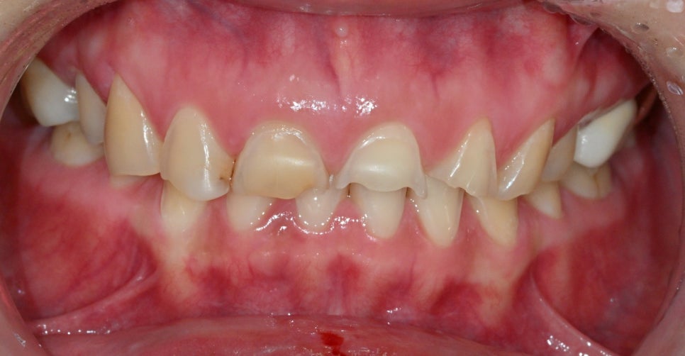 Treatment with Objetto Laminate Veneers After a Chipped Front Tooth image 1