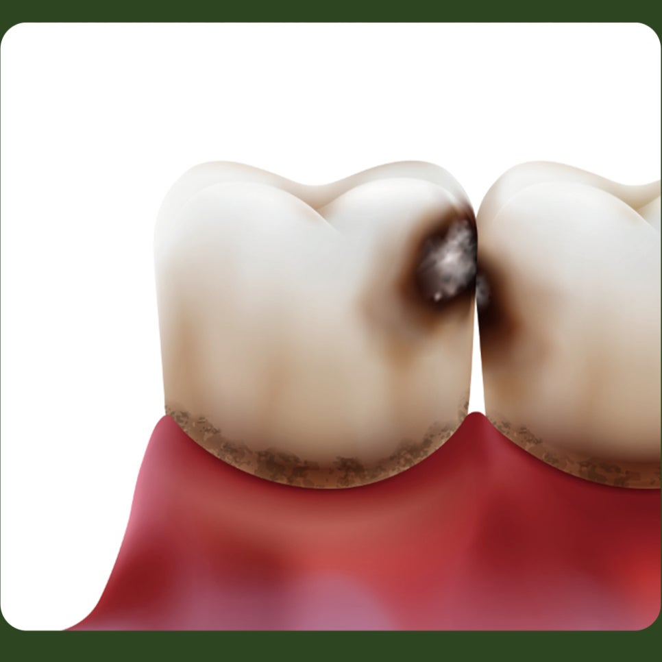 Cavities Between Teeth: What Causes Them and How Are They Treated? image 4