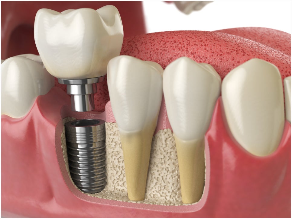 What Is Second-Stage Implant Surgery? Find Out Here! image 4