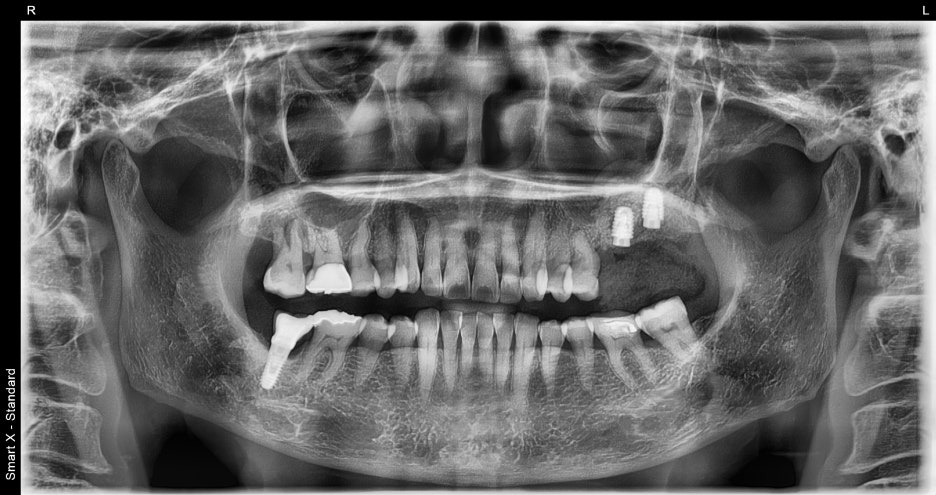 Songpa Dental Clinic: Is Insurance-Covered Implant Treatment Possible? image 15
