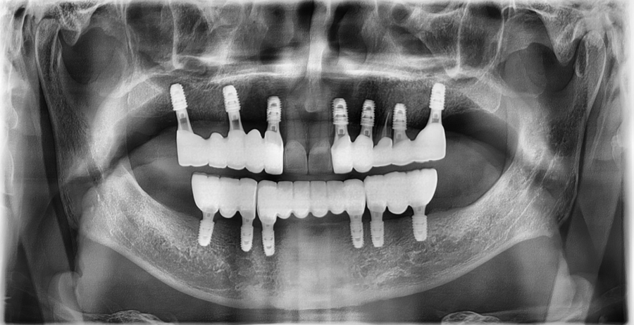 Front Tooth Laminate Veneers Are Natural Even at 70 — A Senior OVZERO Treatment Case image 10