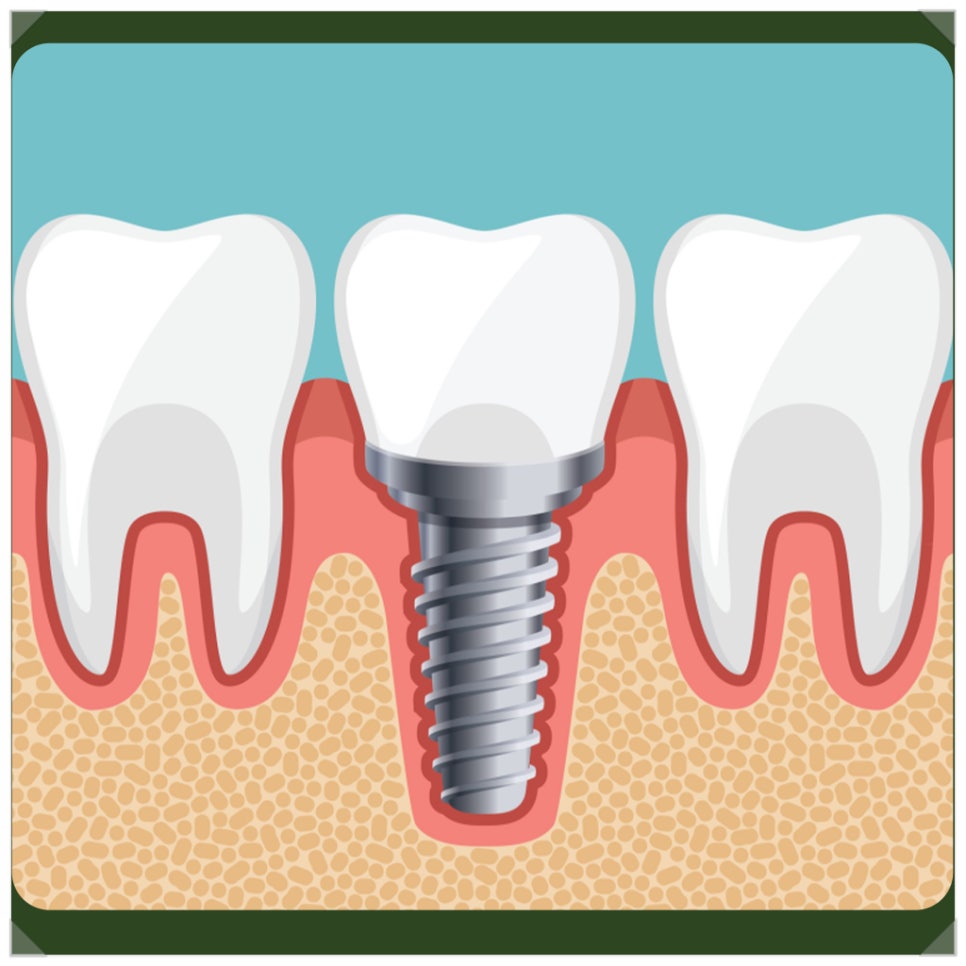 Please Make Sure to Attend Your Regular Implant Checkups! image 5