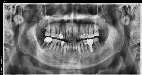 Is the bleeding from your gums not stopping? A case that raised suspicion of leukemia image 1