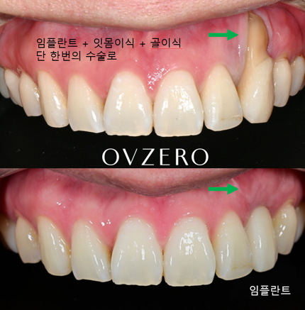 앞니 임플란트, 잇몸까지 살려야 하는 이유 관련 이미지 7