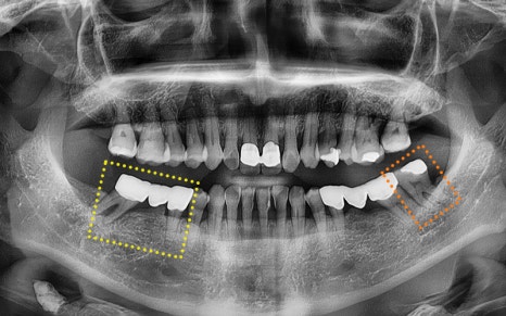[Seokchon Gobun Station Dental Clinic] When Is an Implant Needed? image 9