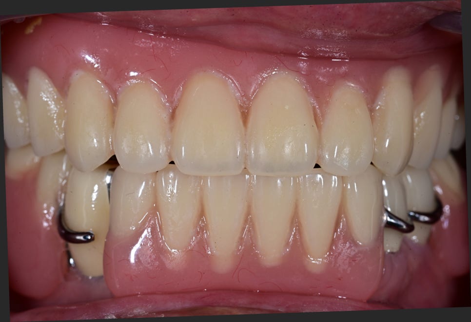 If Your Denture Keeps Coming Loose, What Should You Do? A Real Case Solved with Insurance-Covered Implant Dentures image 9