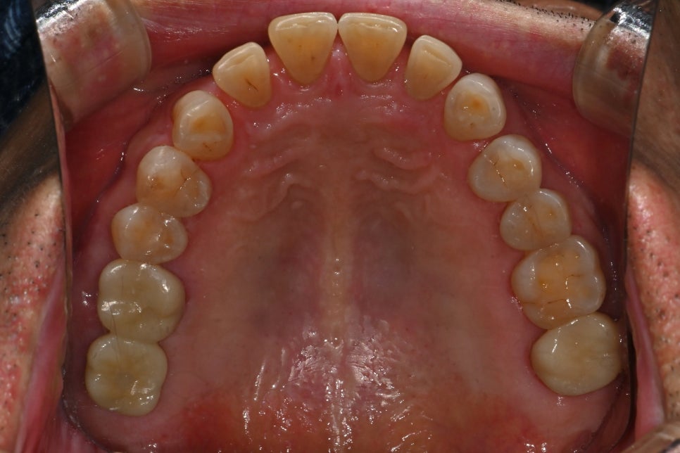 Things You Must Check Before Implant Treatment image 30