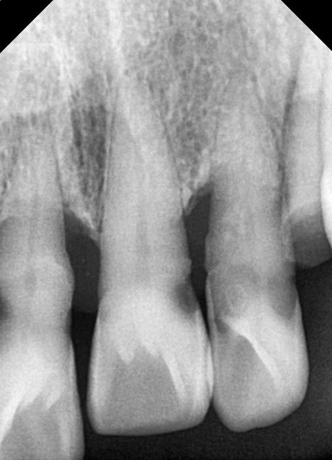 앞니 임플란트, 전치부 심미까지 살린 치료 과정 정리 관련 이미지 11