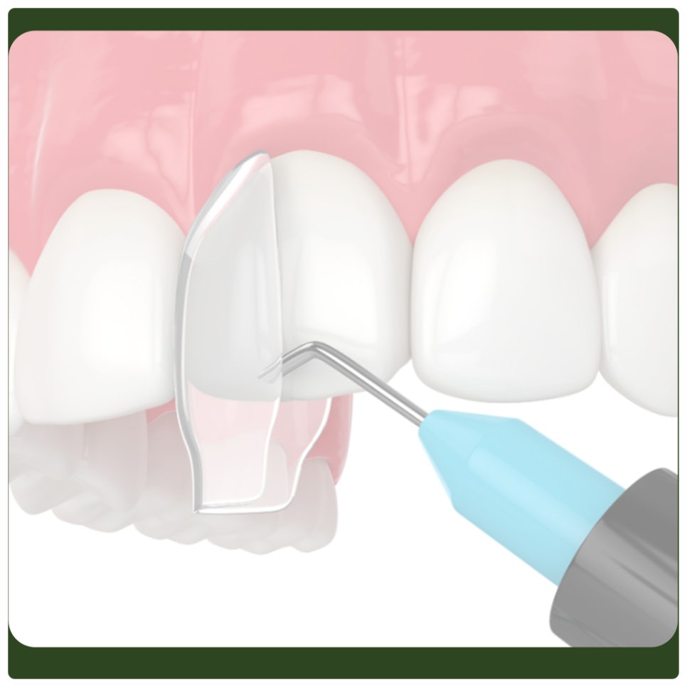 Eating After Resin Treatment: What Should You Be Careful About? image 3