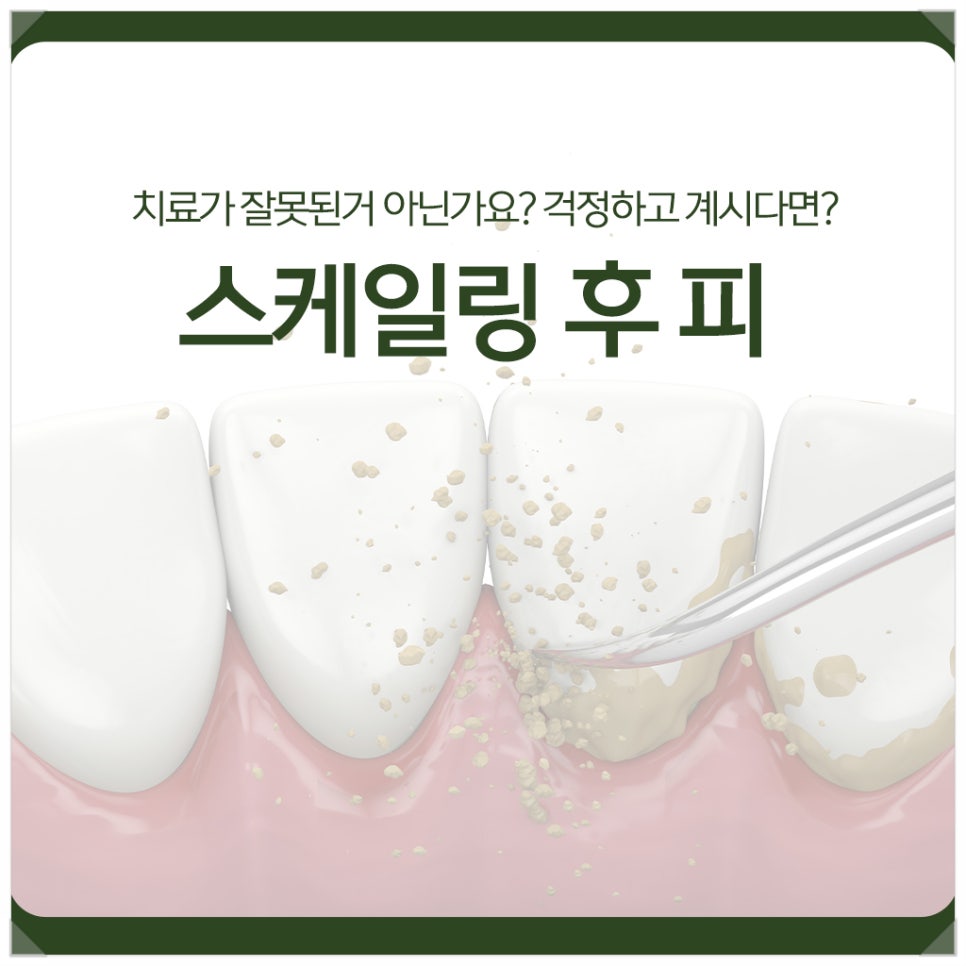 Bleeding After Scaling—Is Something Wrong with the Treatment? If You're Worried image 1