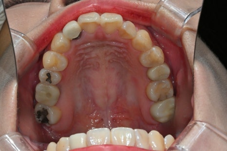How We Naturally Improved an Upper Front Tooth Crown Retreatment, Including Color Differences and the Gum Line image 6