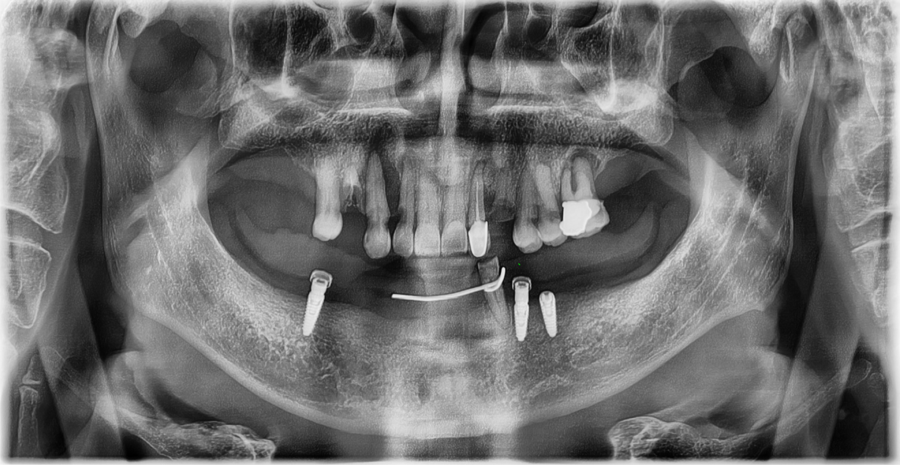 Front Tooth Laminate Veneers Are Natural Even at 70 — A Senior OVZERO Treatment Case image 3