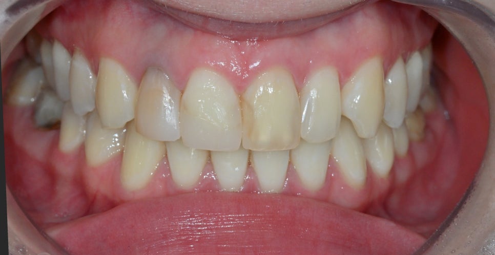 Discolored Front Teeth: Are Crowns the Only Answer? image 3
