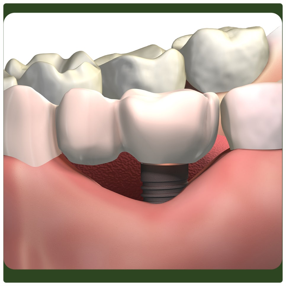 Peri-Implantitis: Proper Care Is Needed to Prevent It! image 2
