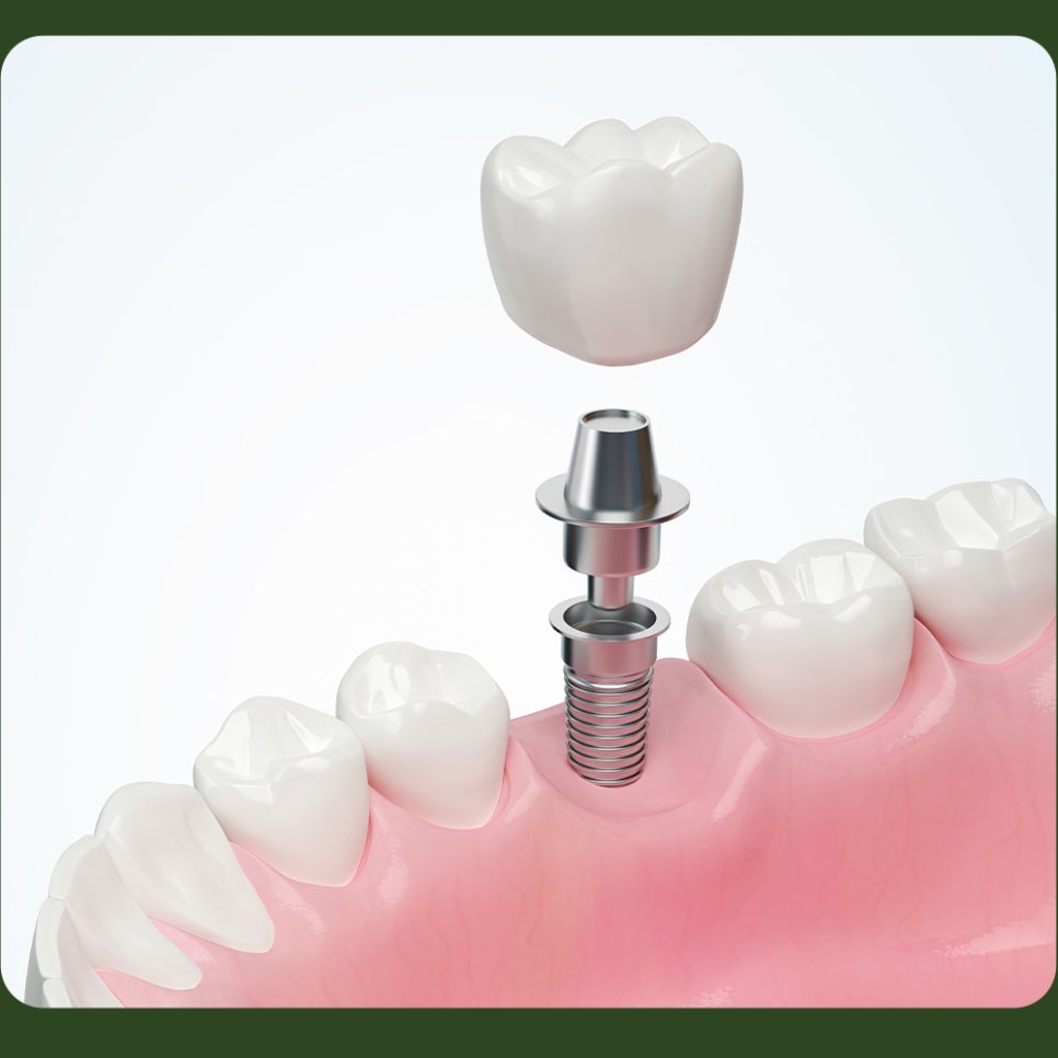 When Is Bone Grafting Needed for Implants? image 2